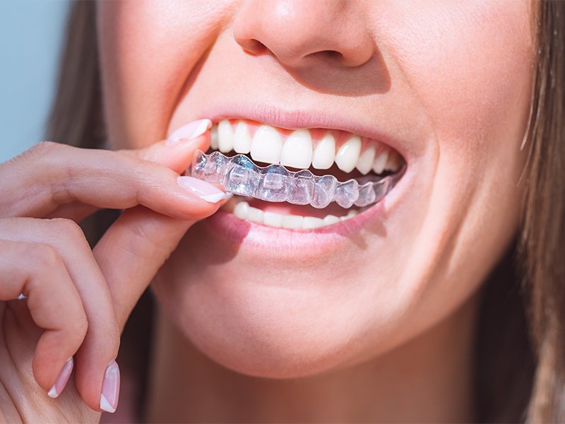 Achieving a Confident Smile: Exploring Invisalign for Discreet Teeth Alignment