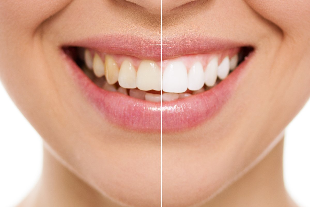 How To Achieve A Brighter Smile With Professional Teeth Whitening At Skyview Ranch Dental Clinic