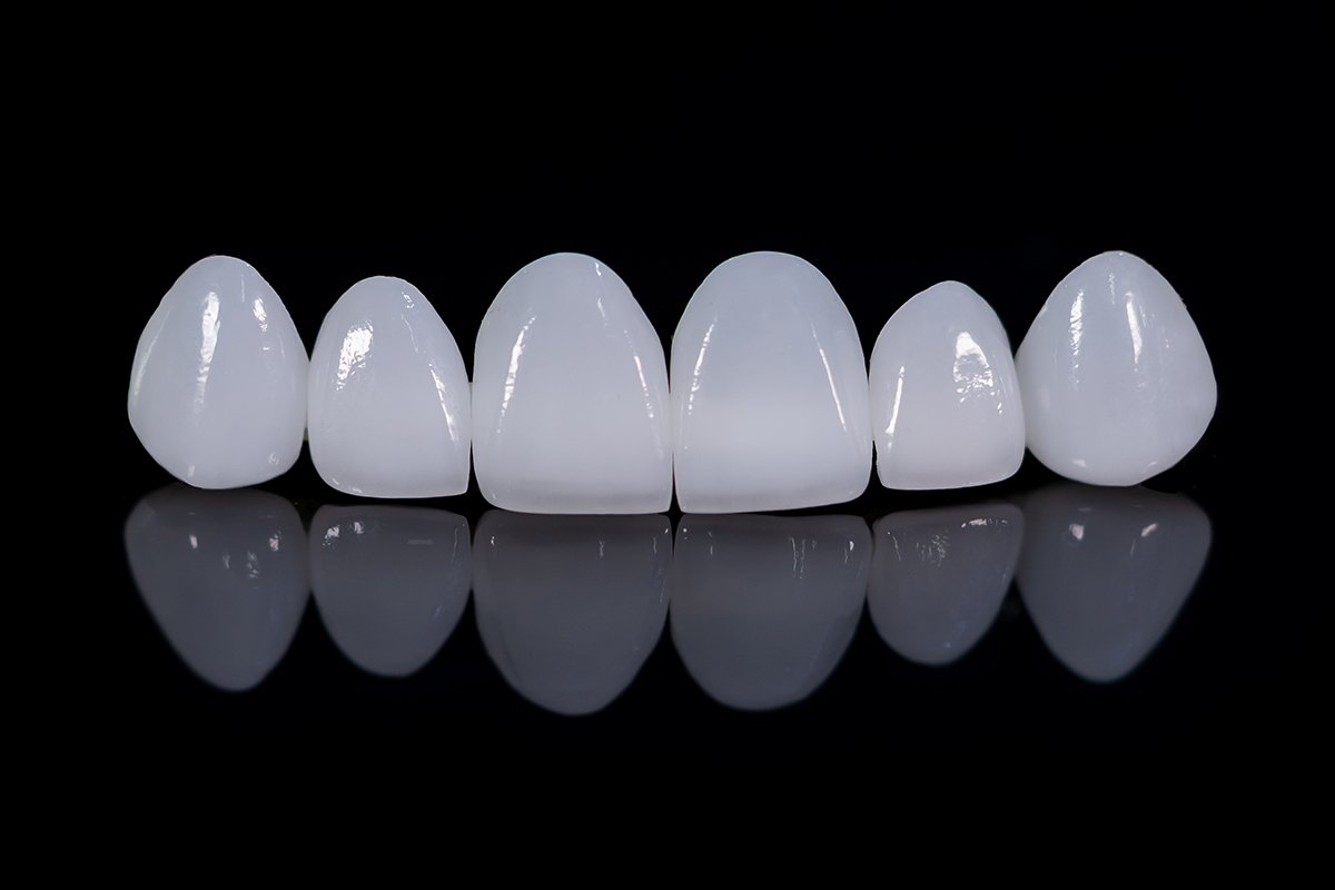 Learn About Discreet Teeth Alignment in Calgary, AB