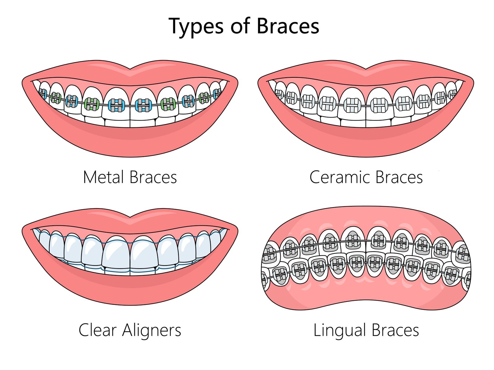 What are the different types of braces available for teeth straightening?