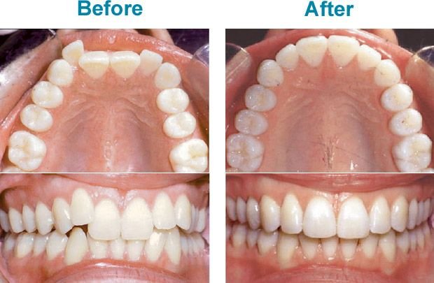 Invisalign Overbite: Before and After Results You’ll Want to See